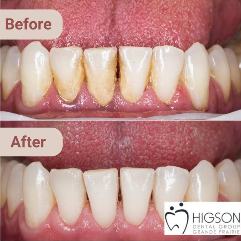 ابتسامتك هي سر جاذبيتك.. لا تدع التكلسات والتصبغات تخفيها! ✨
هل تعاني من اصفرار الأسنان أو تراكم الجير (التكلسات) المزعجة؟
في عيادات [كلية طب الأسنان - جامعة ميسان]، نقدم لك جلسات تنظيف الأسنان وتلميعها للتخلص من:
✔️ التصبغات الناتجة عن الشاي، القهوة، والتدخين.
✔️ التكلسات والجير الذي يسبب التهابات اللثة ورائحة الفم الكريهة.
استعد ثقتك بابتسامة صحية وناصعة! 🦷✨
عملنا يتم تحت إشراف نخبة من أساتذة الكلية لضمان أفضل نتيجة وأعلى معايير التعقيم.
📍 المكان: [عيادات كلية طب الأسنان - جامعة ميسان]
للحجز على الخاص او على رقم الواتساب 
***********
