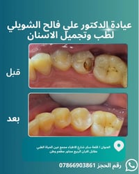 حشوة جذر • حشوة ضوئية • قلعة سكر