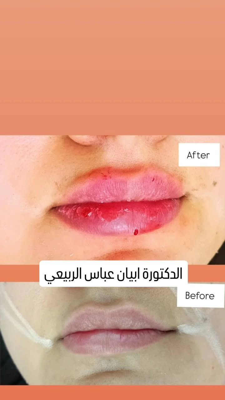 ✨ عروض التجميل غير الجراحي ✨
لفترة محدودة فقط 🤍
💋 فلر شفايف كوري 45 ألف بدل 60 ألف
💋 فلر شفايف إيطالي 60 ألف بدل 80 ألف
✨ فلر تغيير شامل 175 ألف بدل 225 ألف
💉 بوتكس 100 ألف بدل 125 ألف
🌸 إبر نضارة وتبييض 30 ألف
🐟 إبرة السلمون 70 ألف
🧡 إبرة العنبر 50 ألف
🌿 إبرة التصبغات 35 ألف
🧵 تقطيع ألياف 50 ألف
🧵✨ تقطيع ألياف + إبر نضارة 65 ألف
👁️ بوستر العين لتقليل الهالات 75 ألف
📍 العنوان: بغداد – الزعفرانية – شارع المعهد
Dr. Abyan Abass
📲 للحجز والاستفسار (واتساب):
***********
***********
✨ لا تضيعين الفرصة، احجزي موعدج هسه واستفادي من عروضنا المميزة مع الدكتورة  أبيان عباس 💉🤍
