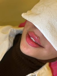 فيلر الشفاه • عيادة سنايا • كربلاء الجمعية