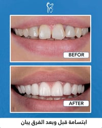 عيادة أسنان • زراعة أسنان • تقاطع الباني