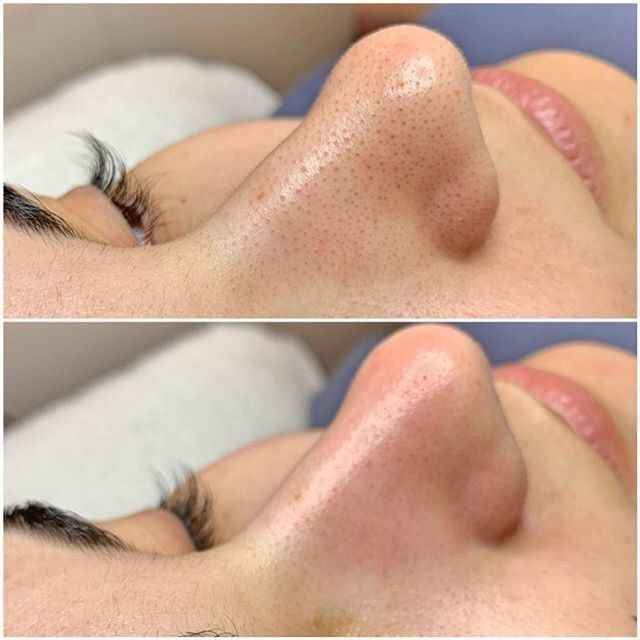 عرض  جميل للبشرة  
الي عدهم رؤؤس سوداء  الي  بشرتهم  دهنية والي عدهم دهون بالوجه  
تقليص  المسام وتخفيف
💘جبتلكم عرض للتخلص من البشرة الي تعاني من دهون زائده والمسامات الواسعة وكذلك الرؤوس السوداء لكل بنوته تحلم ببشرة صافية خالية من العيوب 😉❤️

قولي وداعاً للرؤوس السوداء والبيضاء👃
مع ماسك وكريم لانبينا لإزالة الرؤوس السوداء والبيضاء

قناع مزيل للرؤوس السوداء، تنظيف المسام، تقشير، تنقية طبيعي للوجه 
لجميع انواع البشرة 😍😎 
عميق للمسام وحب الشباب

⚫جهاز شفط الدهون من الوجه✔️✔️
⭕ماركه اوربيه  ⭕
جهاز ازالة الدهون والرؤس السوداء من الوجه
متعدد الروؤس لكل راس عمل معين
للمسامات الواسعه 
والمتوسطه 
والحساسه 
تنظيف البشرة من التراكمات التي تسبب البثور

💙 تونر السالسيلك اسد من #بانوكسيل 💙

يقوم بإزالة حب الشباب وفتح المسام باستخدام PanOxyl Clarifying Exfoliant 2% Salicylic Acid. 

 يساعد حمض الساليسيليك، ، على إذابة الجلد الميت وتقليل إنتاج بعض زيوت الجلد. يزيل التقشير المنتظم تراكم الزيوت، مما يؤدي إلى بشرة أكثر نعومة ونقاء وخالية من البثور🌿
يحتوي هذا العلاج اللطيف للتقشير على أعلى تركيز من حمض الساليسيليك المتوفر بدون وصفة طبية

سعر العرض 28الف بغداد, العراق


**إذا كنت صاحب هذا الإعلان وتريد حذفه لأي سبب، رجاءا أرسل رسالة إلى الدعم الفني**