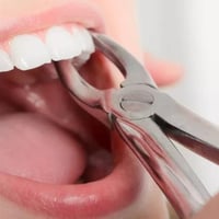 قلع أسنان مجاني • جذور أسنان • الجامعة الوطنية