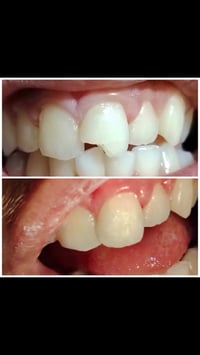 حشوة تجميلية • جلسة واحدة • بعقوبة التحرير