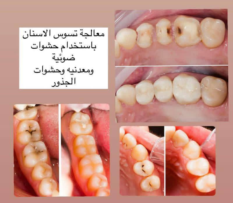 سلام عليكم 
 يتوفر تنظيف أسنان  حشوات ضوئية (تجميلية) قلع الاسنان والجذور التالفة تعويض الاسنان المفقودة (طقم اسنان متحرك) العلاج مجاناً تحت اشراف اطباء مختصين موقع : السعديه قرب مول حارث  ***********  للتواصل واتساب
