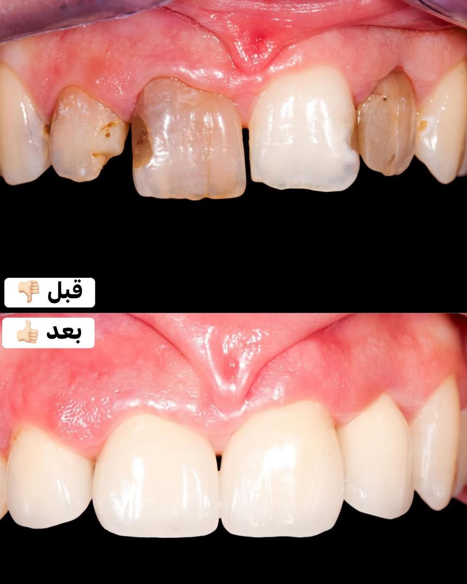 حتى أصعب الأسنان متصعب علينا ✨🦷
شغلنا مو بس علاج… شغلنا دقة ونتيجة تخلّي ابتسامتك غير 💙

ومن شغلنا لهل أسبوع 👇
✔️ حشوات أمامية تجميلية
✔️ حشوات جذور للأسنان الخلفية ويا إعادة بناء السن
✔️ تغليفات زاركون وإيماكس
✔️ تنظيف وإزالة تصبغات

وبما إن عروض الشهر اللي فات عجبتكم كلش ❤️

💥 رجعنالكم بعرض أقوى هالشهر 💥

🎊 أول حجوزات ليومي الثلاثاء والأربعاء🆎:
✨  الهم جلسة تنظيف  وتلميع مجانية

* بالإضافة عروض حلوة ومميزة داخل العيادة على باقي الخدمات

⏱️ العرض محدود وعلى أول حجوزات بس!

📞 للحجز: ***********
او ع الدايركت 
🕓 من 4 العصر للـ 9 مساءً

💙 غايتنا رضاكم وثقتكم
ويا عيادة الجمال… ابتسامتكم تصير أحلى 😍✨
