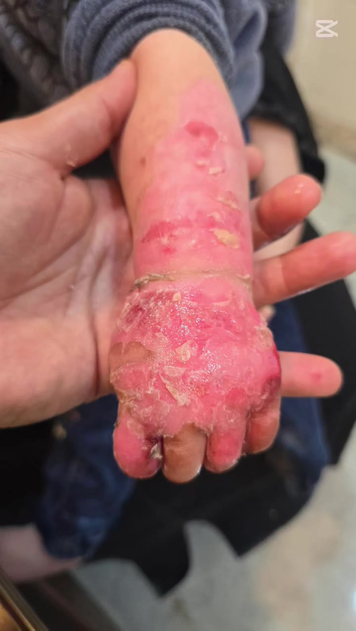 اجاني طفل👼 محتركة ايدة و مودي لاكثر من مكان و ايده متستجيب للعلاج
لحدما اجاني للعيادة و لله الحمد بفضل خبراتنا بالضماد و معالجة الحروق و باستخدام خبطتنا الخاصة كدرنا نرجع ايده مثل مجانت وافضل همين
📍موقع العيادة شارع الطي عمارة ماركت سيلمانية بداية نزال سليم 
وكذلك متواجدين  واتساب ***********
اذكرونا بدعوة💙
