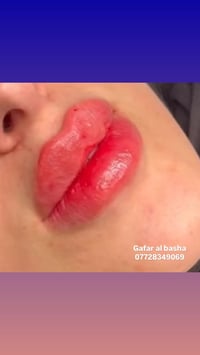 فيلر. الشفايف 👄👄 نستخدم  فيلر الشفاه لعدة اسباب منها  🌸 تحسين مظهر الش...