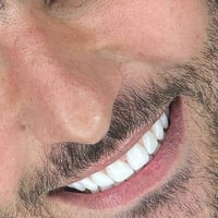 ✨ ابتسامة بدون برد... لأن الثقة تبدأ بابتسامة طبيعية.  ابتسامة متناسقة...