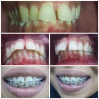 تقويم الأسنان لدينا  بيد أمهر دكتور  اختصاص  تقويم  بنتائج ممتازة و اس...