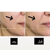​💡 سرّ النتيجة الطبيعية للخطوط الضاحكة! كثيرون يعتقدون أن علاج خطوط ال...