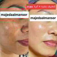 اجمل رسماة  الشفاه  ازالة التجاعيد شد وامتلاء الوجه  ازالة تجاعيد اليد...