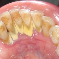 الي عنده هيج تكلسات نظفها اله بلاش بعيادات جامعة الإسراء للحجز 0774866...