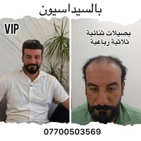 زراعة شعر • بغداد زيونه • تقنيات متطورة