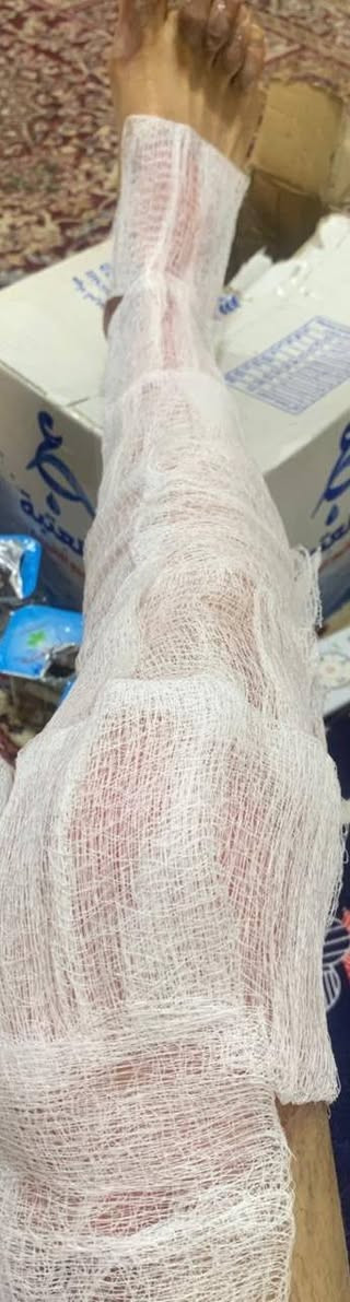 #ضماد_حرق_درجة_ثانية
يوجد لدى عيادتنا كادر متخصص لعلاج و متابعة حالة الحرق من اول يوم إلى حد اكتساب الشفاء التام و يكون الضماد و المتابعة منزلية لا تحتاج إلى زيارة العيادة او مركز الحروق
نختصر عليك الوقت و الجهد و التكلفة

للتواصل
*********** واتساب
*********** اتصال

الله يحفظكم من كل سوء 🤍

 الصور👇 من متابعتنا لشخص محترق بالغاز أثناء عمله في المطعم
يسكن في مجمع الاميرات الثاني
