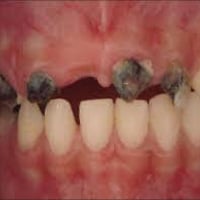 اخواان منو عنده اسنان تالفه او بقايا جذور تالفه تحتاج قلع  مجاااااني م...