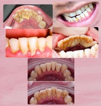 اللي محتاج تنظيف لاسنانه وعنده تكلسات العلاج مجاني ٠٧٧٠٨٠٥٦٧١٩ يتواصل ...