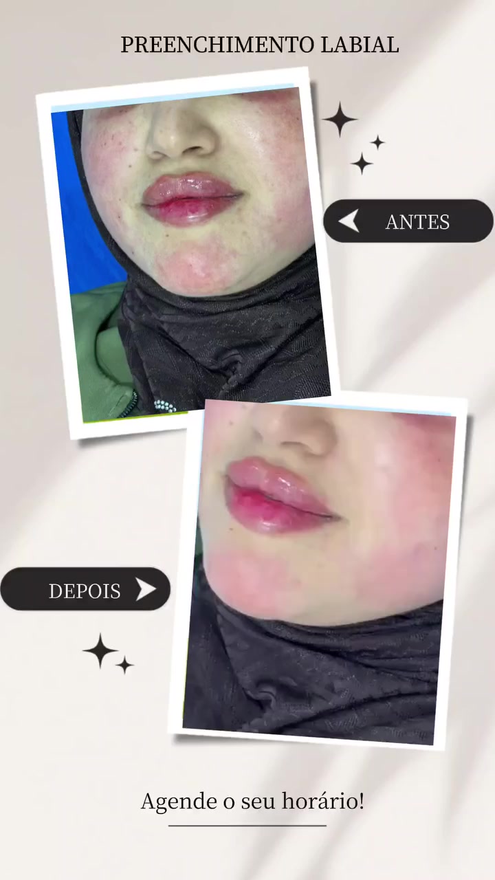 👄 جمالكِ يبدأ من ابتسامتكِ..
​تألقي بفلر شفايف طبيعي، يبرز جمالكِ ويمنحكِ الترطيب والامتلاء المثالي بدون مبالغة.
​🔥 أقوى عروض الفلر:
​فلر كوري (1 سيسي): 30 الف فقط.
​فلر كوري درجة أولى: 50 الف.
​📍 مجمع القمة الطبي: المحمودية - شارع الأطباء.
📞 للحجز السريع (واتساب): ***********

​احجزي الآن وكوني جاهزة للعيد
