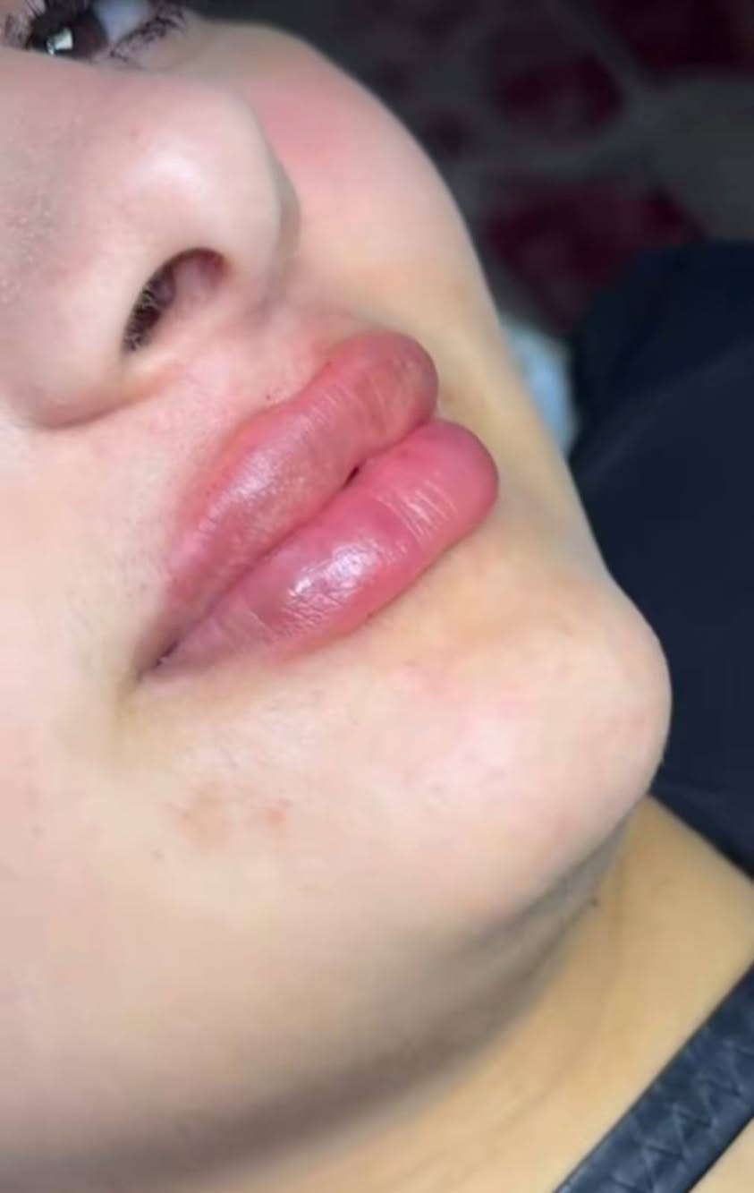 أحلا وأجمل العروض
1- قسم الاسنان 
حشوات تجميليه ب20 ألف أو 25 الف حسب تلافه ألسن 
تنضيف أسنان وبولش للاسنان ب 20 ألف 
تركيب الزاركون الألماني السن الواحد 75 ألف مع تنضيف أسنان واللثة مجاني بعد العمل

2-قسم التجميل والحقن للرجال والنساء 
فلر شفه أو وجنات 25 ألف 
تغيير شامل 250 الف
بلازما مفعله للوجه أو للشعر 15 الف
ميزو تساقط الشعر 35 الف
ميزو نضاره البشره 35 الف
ميزو تصبغات 35 الف
تنضيف عميق للبشره 15 الف

3-قسم الليزر 
ليزر الكانديلا الثلجي 
جلسه ازاله التاتو 10 الف
ليزر ازاله الشعر 15 الف
ليزر تحديد وجنات 15 الف 
ليزر رقبه كامل 20 الف
ليزر فل بدي جسم كامل 120 الف

مركز ايفا لتجميل الوجه والأسنان العنوان مدينة الصدر الكياره قطاع٦٧ مقابل نادي الجولان
‏‪***********‬‏📞

فحص ومعاينة مجاني يوميا مع اشعه للاسنان#
