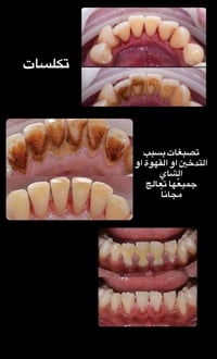 اي شخص يحتاج تنضيف اسنان يتواصل ع الخاص او على الرقم 07834341911