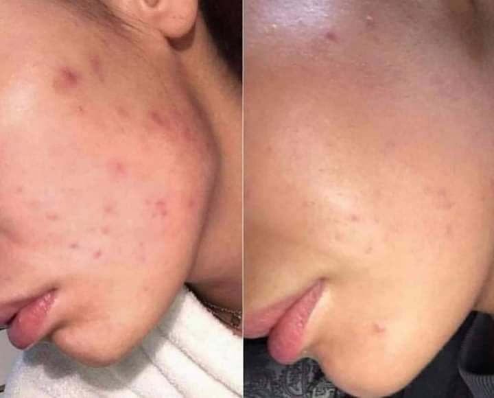 ‎خلطة رجالية /نسائيه

‎لتبيض الوجه 🔴علاج الكلف بالوجه حب الشباب واثاره 🔴التصبغات 
‎و عدم صفاء ونقاوة البشره 
‎الهالات السوداء

‎ خلطه تبيض الوجه وازالة الكلف والنمش المنتج
‎🌹خلطة  السحريه لتبيض الوجه  وبمفعول دائمي 😍
‎كل هذا بسر نجاح خلال اسبوع فقط لاغير لان سر جمالك هو اختصاصنا😍
‎المنتج مضمون ١٠٠٪


**إذا كنت صاحب هذا الإعلان وتريد حذفه لأي سبب، رجاءا أرسل رسالة إلى الدعم الفني**