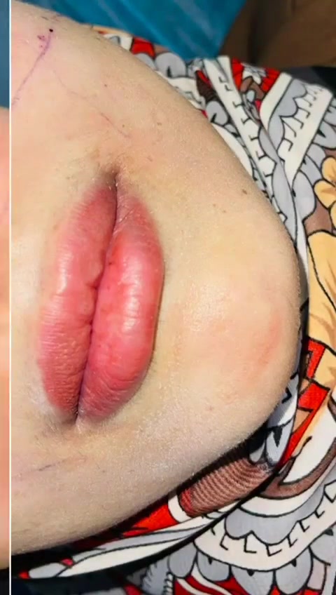 حقن فلر لشفة محقونة سابقاً 

عيادة الماسة لطب الاسنان والتجميل 

للحجز والاستفسار 
***********

#حقن #شفة #فلر #تجميل #اسنان #عيادةـالماسة #الرمادي
