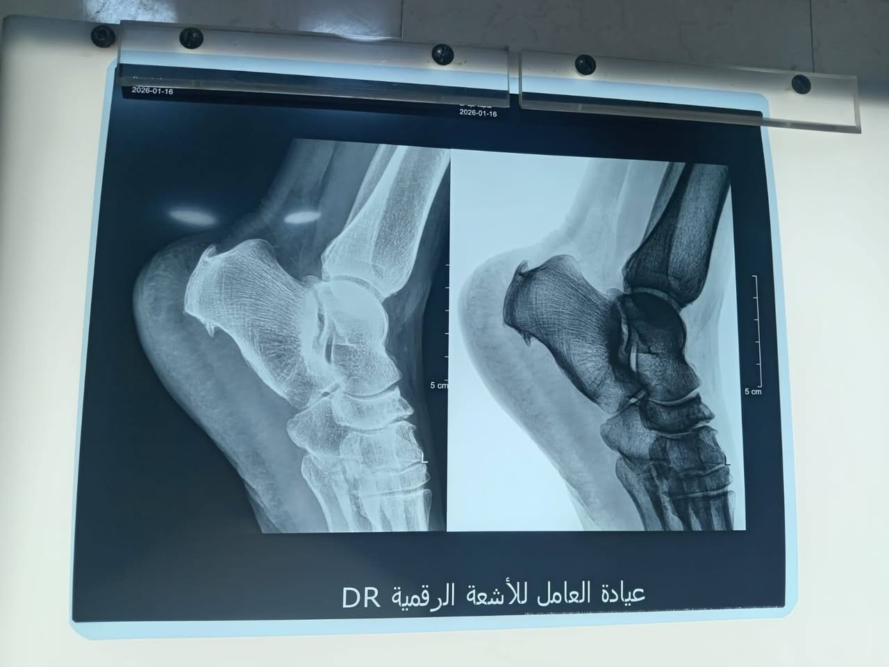 معاناة النتوء العظمي في الكاحل ودور الاشعة 😣

من اكثر اسباب الام اسفل القدم هو النتوء العظمي
اهم اسباب تكون النتوء العظمي زياده الوزن والوقوف الطويل
يتم التشخيص بواسطه اخذ الرقوق الشعاعيه والتي تظهر النتوء على شكل زياده عظميه على سطح عظم العقب
وبالتالي تسهل التشخيص الطبي والعلاج ..
اخذ الرقوق الشعاعية المبكر عند الاحساس بالم اسفل القدم يجنبك ازدياد حجم النتوء وبالتالي الابتعاد عن التداخل الجراحي المتعب والمكلف لرفعه  
وان المراحل الاولى يمكن علاجها طبيا وبدون جراحه
سلامتكم—- اهتمامنا ✅
لازم تنورونا بعيادتنا
عيادة العامل للأشعة الرقمية
باحدث الطرق وبكادر نسوي متمرس
والعيادة طابق ارضي
اوقات العمل طيلة ايام الاسبوع مع يوم الجمعة من الساعة (4-8) مساءً
للاستفسار الاتصال على الرقم :***********
