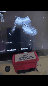 عدنا والعود ُ أحمدُ 😍....
حالة حمل جديدة تسجل للعيادة 🤲🏻
مريضة تعاني من عقم ثانوي لمدة 4 سنوات 
تم تشخيص الحالة على انها انقلاب الرحم الناتج من التصاقات لعمليات سابقة 
تم تحرير الالتصاقات واجراء محاولة الحمل وهاي نتيجة المحاولة الثانية
كيس حمل جميل❤️

نسأل الله التمام بالسلامة للأم والطفل 💐

الدكتورة سماء عبدالله آغا 
اختصاص الجراحة النسائية 
شهادة البورد العربي(دكتوراه) في الجراحة و الامراض النسائية والتوليد والعقم
📌الرحمانية_الجعيفر_قرب سوق الرحمانية_مجاور صيدلية زينب باسم وهيب
☎️للحجز المسبق:***********
🕰️دوام العيادة يوميا من (الساعة 4_7 مساءا)
