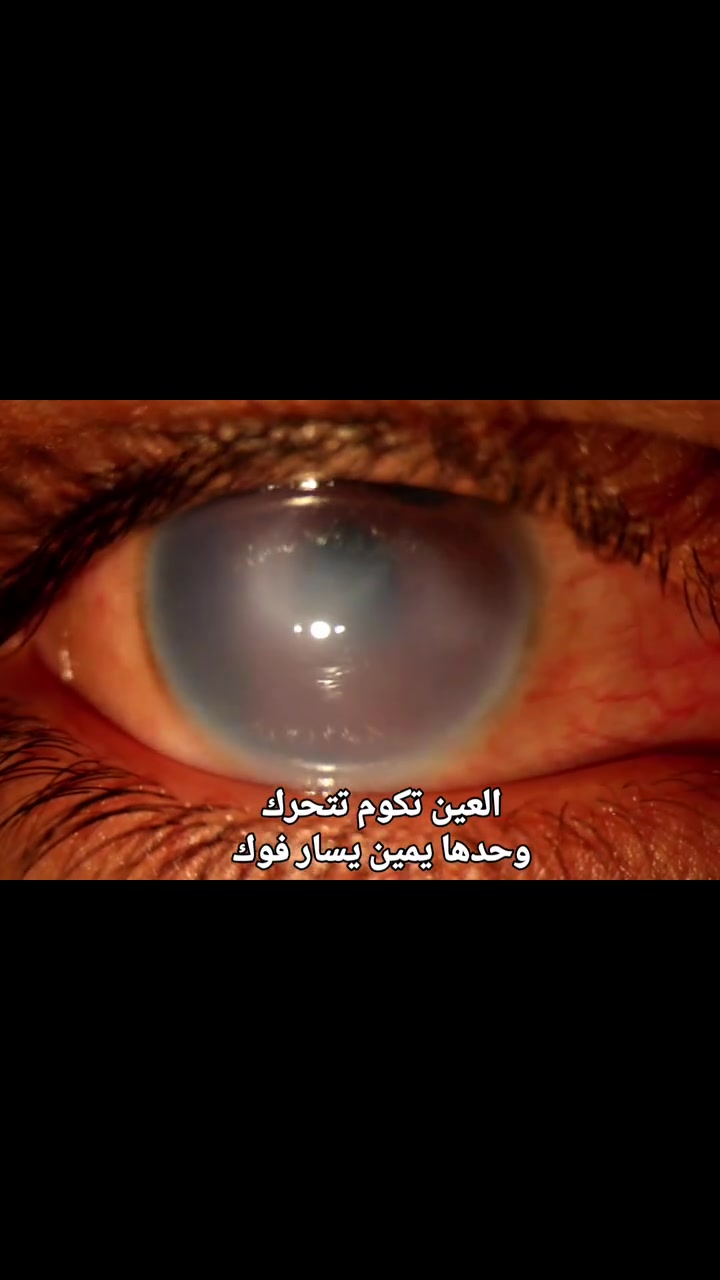 الرآرآة او ال Nystagmus 

ونسأل الله الصحة والسلامة لجميع المرضى 

#الدكتور_حيدر_محمد_فياض_المعموري
عنوان العيادة : مجمع عماد الخير الطبي- مقابل مستشفى المسيب العام
للحجز والاستفسار: 
اتصال او واتساب على الرقم
 ***********

نتواجد جميع ايام الاسبوع عدا الاحد والاثنين عطلة العيادة
 #مسيب #طبيب_عيون
