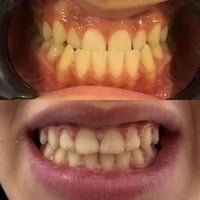 تقويم اسنان • عيادة اسنان • طبيب اسنان • احمد الشريفي • تقويم اسنان طو...