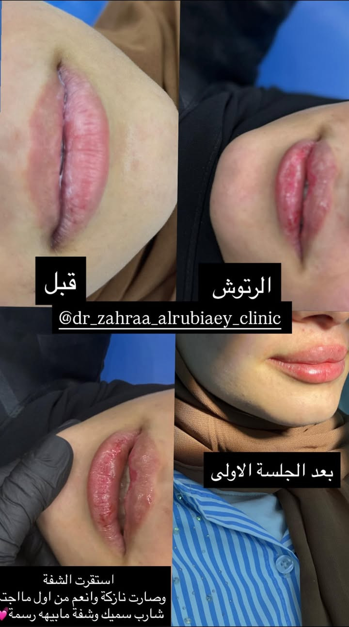 رسمات الوجه والشفه بعيادتنا 💗💗

عروض الصيف نزلت على ابر النضاره والفلر وجلسات التغيير الشامل 
للحجز والاستفسار يرجى مراسلتنا واتساب ***********

علماً مع ابر النضاره يكون تنظيف بشرة مجاناً ✅✅✅✅

العروض راح تنزل بالتعليقات 

العنوان عيادة الدكتورة زهراءالربيعي
شارع البلدية 📍📍📍📍
