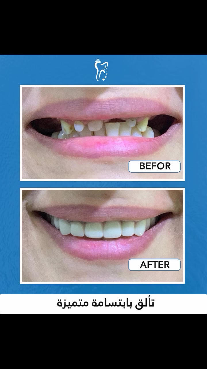 أعتني ب أبتسامتك لأنك تستحق الأفضل 😁😁

في مراكز الشركة الطبية العالمية ، نوفر لك أحدث تقنيات طب الأسنان، وأسهل طرق الدفع.

✅ تقويم الأسنان ✅ تبييض الأسنان ✅ ابتسامة هوليوود
زراعة أسنان 
وحشوات وكتير من الخدمات 

متواجدين داخل المركز طيلة أيام الأسبوع لخدمتكم 

العنوان/القرنة/شارع المستوصف/عمارة شركة بغداد للحاسبات/للأستسفار/***********
  #عيادة_اسنان #طب_اسنان #كي_كارد #KeeCard #دفع_الكتروني #تقويم_اسنان #تبييض_الاسنان #زراعة_الاسنان #ابتسامة #جمال #صحة
