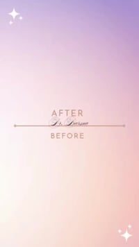 حشوات تجميليه ضوئيه للأسنان الاماميه نفس لون السن تماما جمال... قوه......