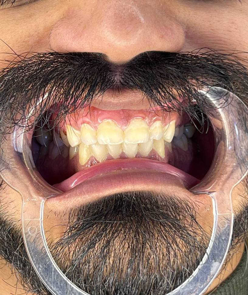 ✨ ردّة فعل المراجع بعد ابتسامته بدون برد! ✨
عيادة الدكتورة هند الحسيني 
الامين الثانيه/النواب(شارع المهداوي
للحجز والاستفسار 
***********
