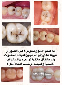 مجاني • حشوات تجميلية • عيادات جامعة المنارة