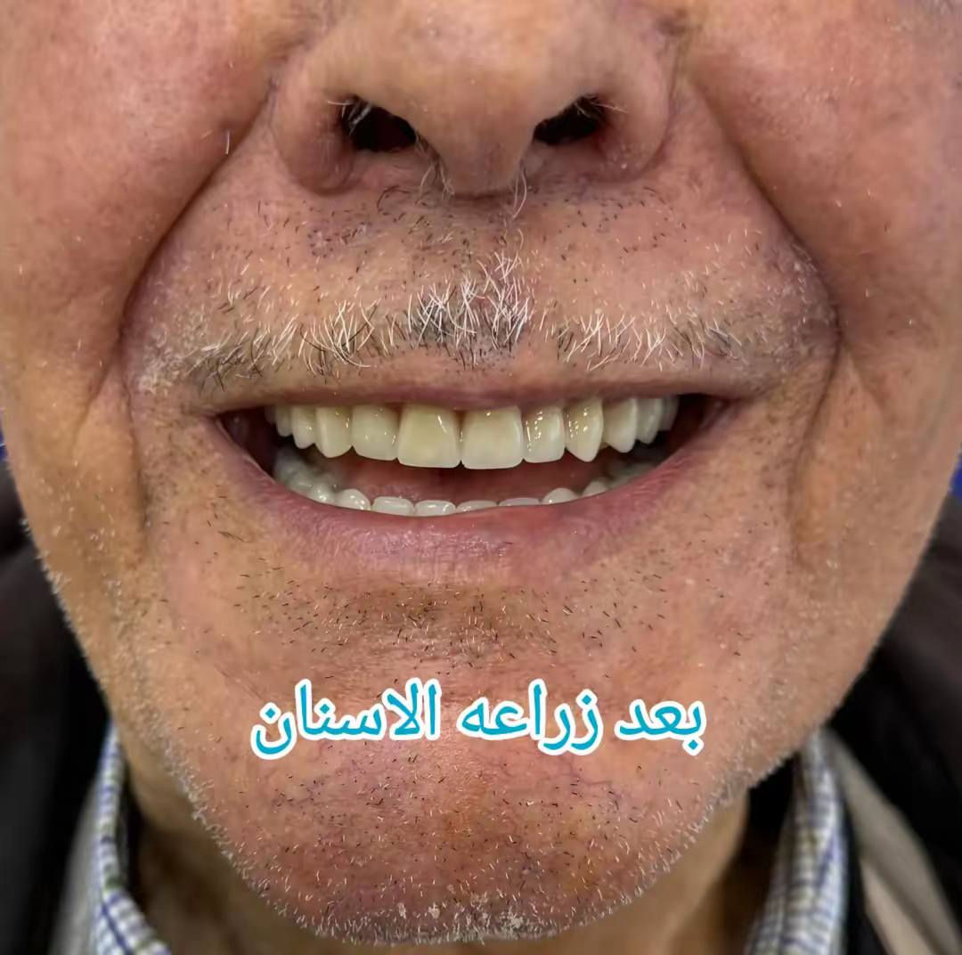 حالة اليوم لمراجعنا من العبيدي 🔥
الحاج أبو علاء الشمري 

زراعه اسنان مع تغليف فك كامل 
باستخدام  ابتسامة (الزاركون _  ألالماني) 🇩🇪

على يد الطبيب الاختصاص 
دكتور يوسف الهدلي 
ماجستير طب ومعالجة الأسنان 
 
خلي ابتسامتك ويانه احلى 🩵

أبتسامتك ~ يمنا  ~ غير ✨😍

ابتسامة ساحرة 🌠

ثقة مضاعفة 😍

علماً كافة الابتسامات والحشوات مع ضمان مدى الحياة 😎

فرع حي النصر

#العنوان
حي النصر/ شارع الاطباء / قرب جامع الأمام المهدي
فوق صيدلية مصطفى جاسم أو أسواق الزعيم 

للحجز والاستفسار 

*********** ☎️

دوام العياده ⏰

الساعة 4 عصرا 

إلى 

الساعه 9 ليلا

