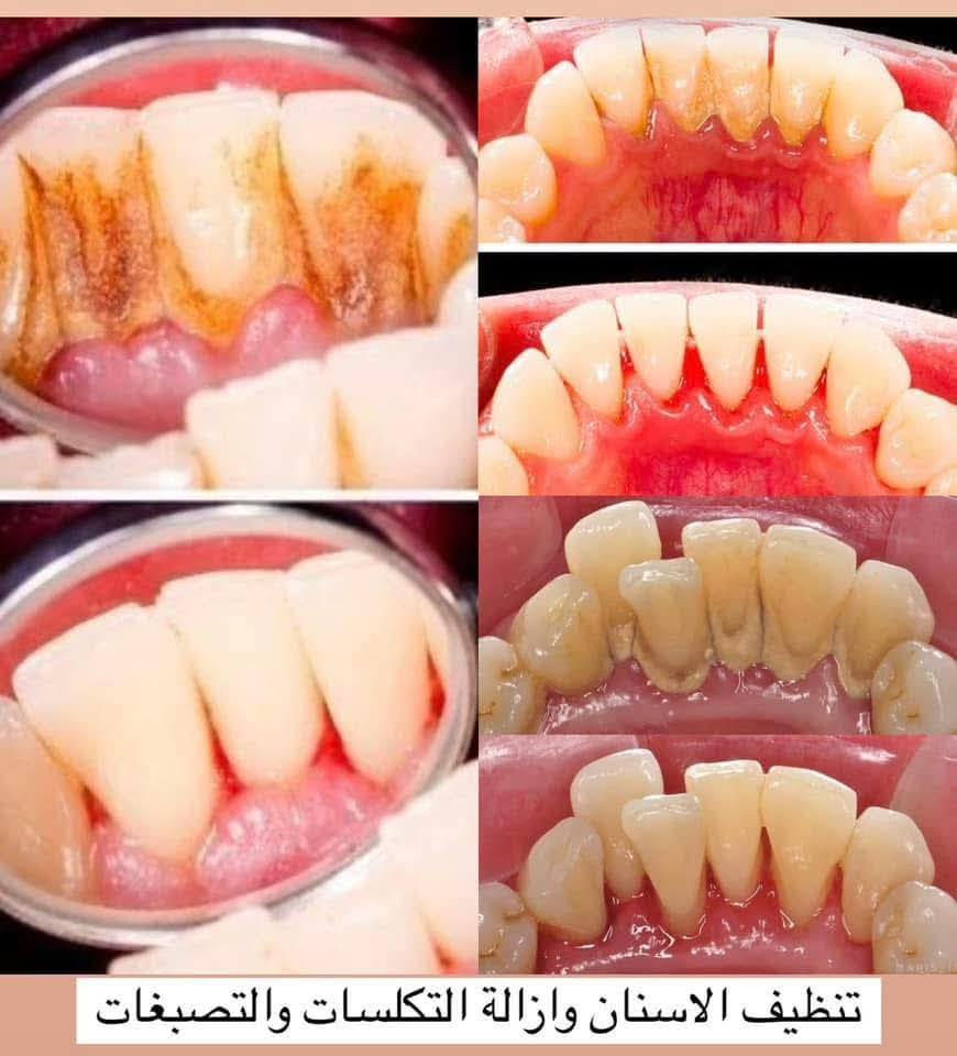 سلام عليكم 
 يتوفر تنظيف أسنان  حشوات ضوئية (تجميلية) قلع الاسنان والجذور التالفة تعويض الاسنان المفقودة (طقم اسنان متحرك) العلاج مجاناً تحت اشراف اطباء مختصين موقع : السعديه قرب مول حارث  ***********  للتواصل واتساب
