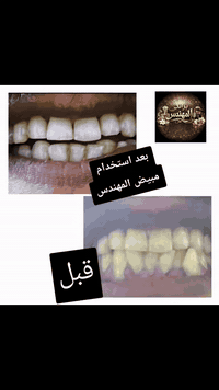 مبيض الاسنان من براند المهندس +هدية+فرشاة اسنان
العلبة الاولى تتكون من مكونات طبيعية ١٠٠٪
العلبة الثانية معجون المكونات الطبيعية
الهدية(عطر او مرطب او غسول او شامبو او احد منتجات البراند) 
للطلب المراسلة او التواصل على الرقم / ***********
كل هذا 25 الف دينار والتوصيل مجاني لكافة محافظات العراق 🇮🇶

* تستخدم المنتج وينطيك نتيجة گبال ابو التوصيل *
