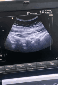 قسطرة القناة العصبية • أرجان محمد رشيد • كركوك شارع الأطباء