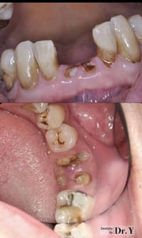 عندك جذر سن مكسور أو سن مستحقة قلع ومأجلها؟ تأجيل القلع ممكن يسبب:  ▫️...