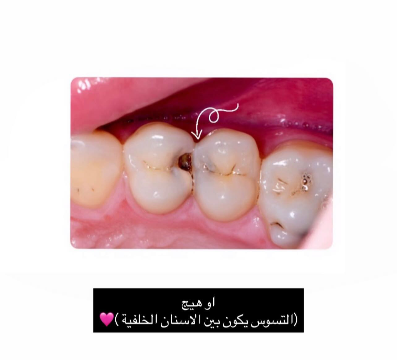 السلام عليكم 
أي شخص عنده هيج تسوسات بأسنانه الاماميه او الخلفيه ويريد يعالجهن يراسلني ع الواتساب او دايركت العلاج مجاني
للاستفسار 📞: ***********
