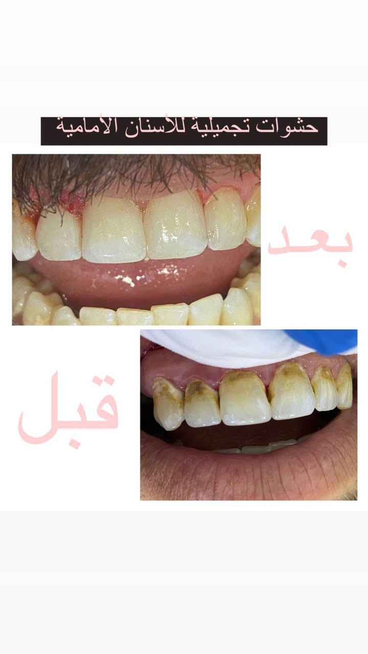 شنو الخبر الي ممكن يفرح اهالي الحسينية !؟ 
عيادة داليتا لطب وتجميل وتقويم الاسنان تقدم خصم 20٪ ع حشوات الجذور والحشوات التجميلية 
العنوان : الحسينية | قرب السوق الصغير | فرع صيدلية العجلان 
Dalya Majeed
***********
