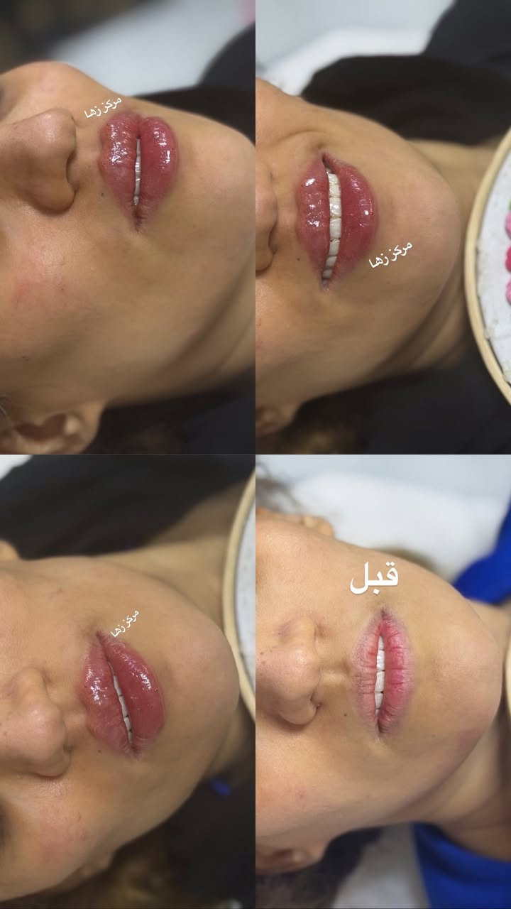 عروض قنبله  الموسم عروض لمده محدوده فقط 
على جميع الأقسام لمده محدوده فقط 

نبدي بأكثر قسم احبه تجميل 

فلر اودري تغير شامل 12 سيسي ب 200 فقط 
فلر اودري تغير شامل 6 سيسي ب 100 فقط 

فلر ابتك تغير شامل  12 سيسي ب 450 فقط 
فلر ابتك تغير شامل 6 سيسي ب 225 فقط 

فلر سويسري تغير شامل 12 سيسي ب 950 فقط 
فلر سويسري تغير شامل 6 سيسي ب 475 فقط 

بكج اميرات زها 
فلر وجنات مع فلر شفه مع جلسه نضاره ب 100 فقط 

بكج اميرات زمرده فلر وجنات مع فلر اصداغ مع فلر شفه مع فلر ذقن مع جلسه نضاره ب 150 

درمابن ب 15 فقط مع تنظيف البشره العادي هديه 
درمابن مع ميزوا ب 20 مع تنظيف البشره العادي هديه 
درمابن مع ميزوا مع تنظيف البشره العميق ب 25

جلسه نضاره ب 35 
جلسه نضاره مكس ب 50 
جلسه نضاره مكس زها ب 75 
جلسه نضاره مكس زمرده ب 100 فقط 

تنظيف البشره العميق فقط ب 10 
تنظيف البشره ملكي ب 15 
تنظيف البشره العادي ب 5 

بكج أميرات زمرده حف وجه مع تنظيف البشره 
مع تنظيف القدم ومع جلسه معالج البارد للشعر كل هذا ب 20 الف فقط 

قسم عرايسنه الحلوات 
حنه مع عرس ب 150 

ميك اب مع تسريحه بسيطه 25 
ميك اب بناتي ب 10 
ميك اب بسيط ب 15 
ميك أب Vip ب 35 مع رموش دائميه او أسبوعيه حسب اختيارج 
كوي شعر ب 10 
سشوار ب 15 
ويفي ب 10 
تسريحه Vip ب 25

قسم الشعر 
صبغ الشعر القصير ب 15 الف فقط 
الوسط ب 20 
الطويل ب 25 
الطويل جدا ب 35 

تخصيل الشعر  القصير ب 25 
الوسط ب 35 
الطويل ب 40 
الطويل جدا ب 50 

قسم التاتو والوشم والرموش 
تاتو بلوك ب 30
تاتو فيبروز ب 50 
تاتو نانو بروز ب 65 
وشم حرف ب 5 فقط 
وشم صغير جدا ب 15 
وشم صغير ب 20 
وشم وسط ب 30 
الكبير من 40 وفوك حسب حجم الوشم 

رموش أسبوعيه ب 5 فقط 
رموش دائميه ب 15 فقط
رموش دائميه ب 25 فقط 3D
رموش دائميه ب 40 فقط 6D

تسريح ومعالج الشعر 

القصير 35 
الوسط ب 45 
الطويل ب 75 
الطويل جدا ب 100 

للاستفسار واتساب *********** ادمونه زهراء 
عنوان سبع البور شارع 60 مقابل مركز الصحي مقابل حسينية اهل البيت ع
