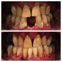 العلاج مجاناً قلع الاسنان المتحركة والجذور المتبقية واسنان العقل حشوات...