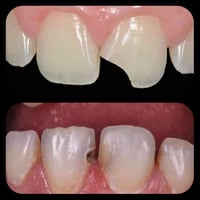 علاج اسنان مجاني • تسوس سن • كربلاء حي النقيب