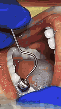 تيجان أطفال • تيجان ستانلس • تيجان بيوفليكس