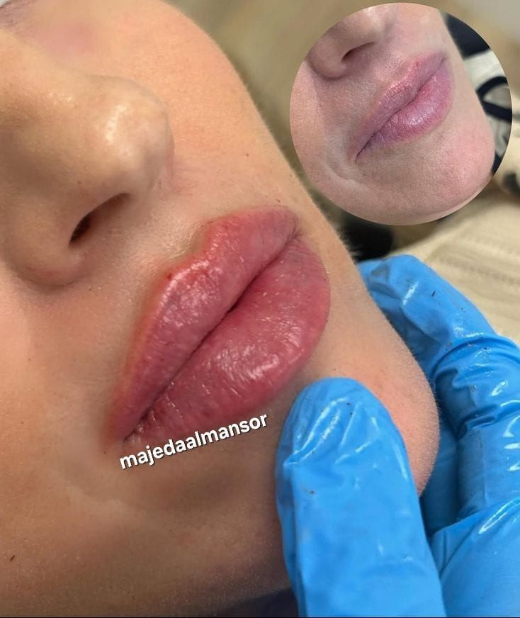 اجمل رسماة  الشفاه 
ازالة التجاعيد شد وامتلاء الوجه 
ازالة تجاعيد اليد 
مواد أمنة واصلية 
الدكتورة  ماجدة المنصور Jojo Alnabeel 
العنوان بغداد الحسينية مقابل السوق الكبير مجاور مرطبات العذراء
مجمع سما الحسينيه الطابق الثاني قسم التجميل والصالون ***********
