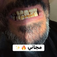 الي عنده تكلسات نفس الصوره ⬇️ يتواصل وياي باجر اخر عياده تنظيف اسنان م...