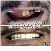 تعويض الأسنان لمراجع فاقد اسنانه لفترة طويلة وارجاع الابتسامة له  الدك...