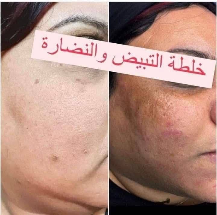 معجزه التبييض خلطة  ايليئا صابون 🧼 هديه
الحل الأمثل 
ًحصريا لدينا اقوى خلطه تبيض الوجه وازالة الكلف والنمش المنتج
🌹خلطة السحريه لتبيض الوجه خلال ٣ ايام فقط وبمفعول دائمي
1:ازالة الكلف والنمش
2:وازالة الهالات السوداء للجلد التالف
3:وازالة حب الشباب واثاره
4:ويرطب البشره وتنعيما
5:ويحمي البشره من الاشعه الضاره للشمس
6: ازاله التصبغات
7:تجديد خلايا الجلد التالفه

😍كل هاذا بسر نجاح خلال اسبوع فقط لاغير لان سر جمالك هو اختصاصنا😍
المنتج من المواد الطبيعيه مضمون ١٠٠٪؜

السعر  35 الف توصيل مجاني 
يوجد خدمه توصيل الى كل المحافظات


**إذا كنت صاحب هذا الإعلان وتريد حذفه لأي سبب، رجاءا أرسل رسالة إلى الدعم الفني**